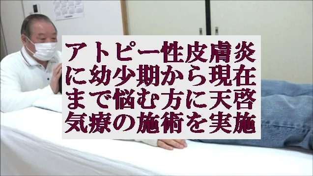 アトピー性皮膚炎に幼少期から現在まで悩む方に本物の気功師にも優る天啓気療の施術を実施